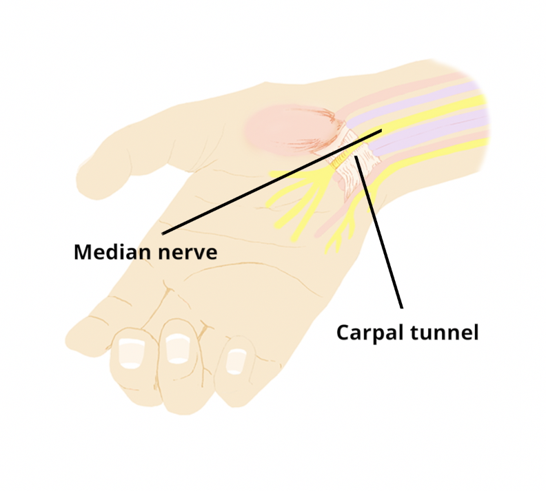 Carpal tunnel syndrome - Circle Integrated Care