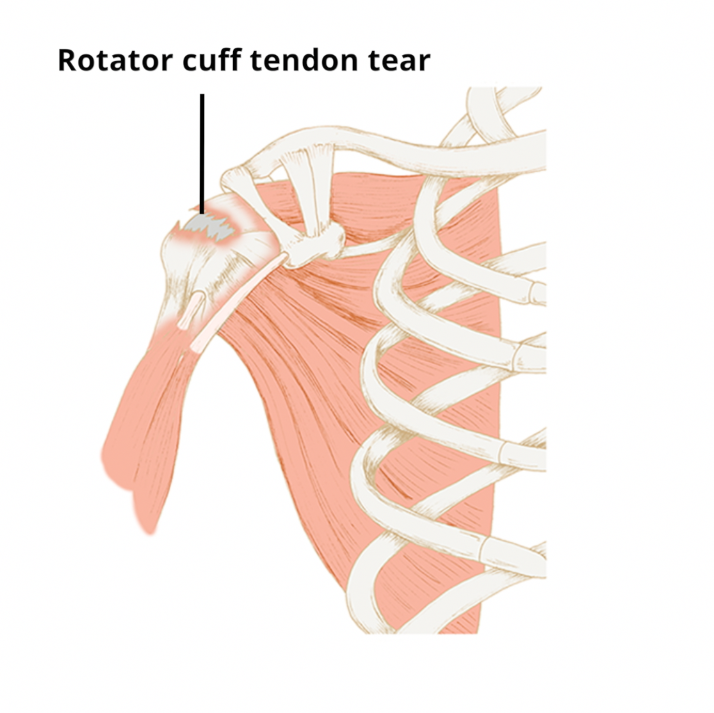 Rotator cuff tear - Circle Integrated Care