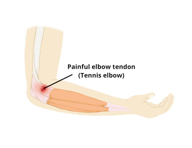 Tennis elbow - Circle Integrated Care